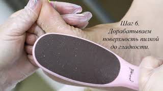 Удаление натоптышей специальным средством Collusolution Justnail