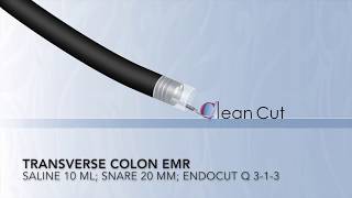 Colonoscopy: Transverse Colon EMR