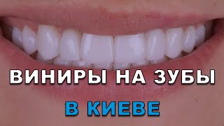 Виниры на зубы Киев (Украина) видео – стоматология Люми-Дент