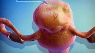 !Миома Матки Симптомы Размеры!|!Mioma Matki Simptomy Razmery!