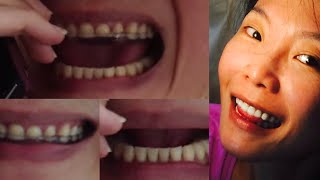 ครอบฟันทั้งปากแบบที่ดาราชอบทำ