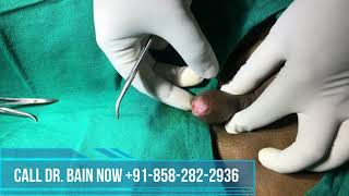 Different type of Phymosis | Dr. Bain Clinic Kolkata - Call +91-8582822936