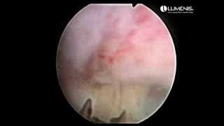 Holmium Laser Enucleation of Prostate ( HOLEP)