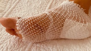 !!!Вот как надо лечить ПЯТОЧНУЮ ШПОРУ