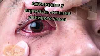 Амблиопия у взрослых: лечение ленивого глаза