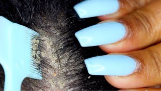 Satisfying Dandruff Removal ASMR |Scalp scratching and picking | Psoriasis PT2