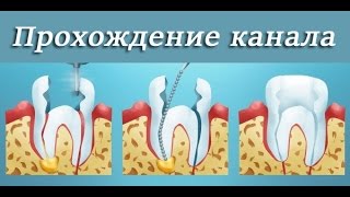 Как расширить корневой канал  Ретейпер, эндодонтия