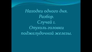 Находки одного дня. Случай 1. Опухоль головки поджелудочной железы.
