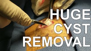 Back Cyst Removal - Dr. Paul Ruff | West End Plastic Surgery
