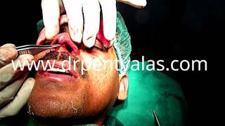 Rhinoplasty For Men
