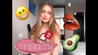 | БРЕКЕТЫ | ЧАСТЬ 2 | Сколько стоит установка брекет-системы? |