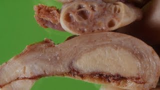 Endometrial Carcinoma - Pathology mini tutorial