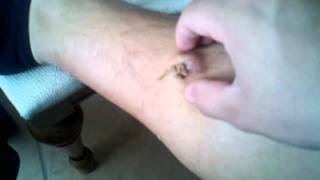 Erics Giant Leg Pimple Part 1