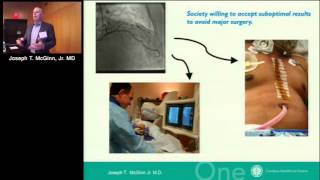 MICS CABG (Joseph T. McGinn, Jr. MD)
