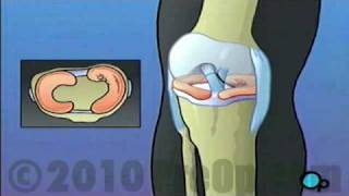 Anterior Cruciate Ligament Arthroscopic Repair PreOp® Patient Education