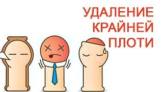 Удаление крайней плоти / Доктор Черепанов