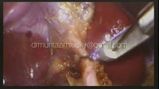 Trans vaginal laparoscopic cholecystectomy Bangladesh (NOTES)
