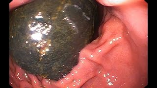 Huge foreign body (phytobezoar) of the stomach - Огромное инородное тело (фитобезоар) желудка