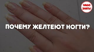 Почему желтеют ногти: причины, и как это предотвратить?