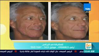 صباح الورد - فقرة خاصة عن "البهاق" مع الدكتور هاني الناظر