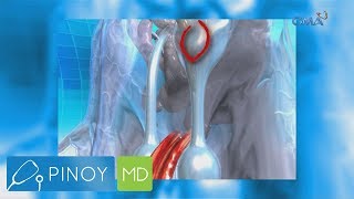 Pinoy MD:​ Isyu ng iregular na menstrual cycle, tinalakay sa 'Pinoy MD'