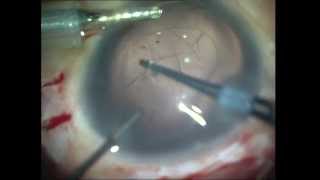Rhexis in Difficult situations Soosan Jacob 7 33 min with audio