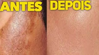 Tratamento facial  que realmente da resultado!! ?