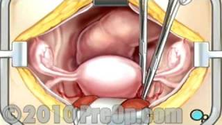 Hysterectomy Removal of the Uterus PreOp® Patient Education Feature