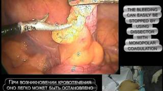 Лапароскопическая аппендэктомия - Laparoscopic appendectomy