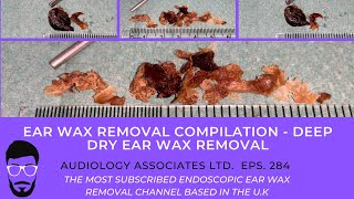 EAR WAX REMOVAL COMPILATION - DEEP DRY EAR WAX REMOVAL - EP 284