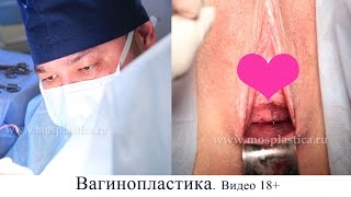 Вагинопластика: видео. 18+ Бакирханов С.К.