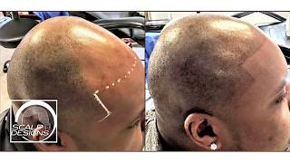 #1 Scalp Micropigmentation in Massachusetts // Scalp Designs