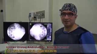 Uroloq -  Böyrək Daşı - Uzman Dr. Araz Bayramov