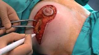Cirugía Oncoplástica. Mamoplastia lateral (Lateral Mammaplasty)