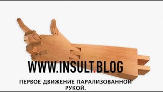 Первое движение парализованной рукой после инсульта.