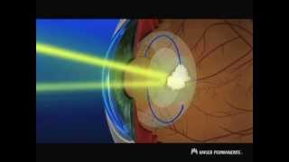 Cataract Surgery