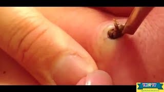 Новое выдавливание ПРЫЩЕЙ и ЧЕРНЫХ ТОЧЕК!  p27