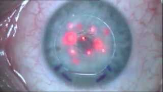 Femto LASIK Operation