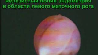 «Труднодоступный» полип эндометрия. Удаление.
