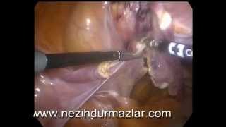 Total Laparoscopic Hysterectomy - Kapalı Rahim Ameliyatı