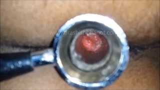 How PILES look ? - Dr. Ashish Bhanot