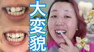 矯正して早２ヶ月やのにいいい‼️