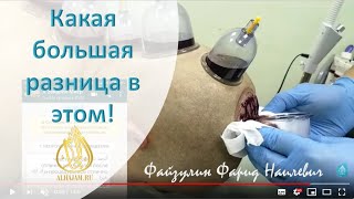 Хиджама на голову и спину Разница حجامة