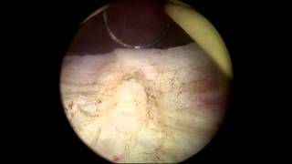 Bipolar TURP