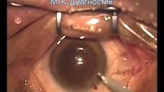 Операция замены хрусталика глаза при катаракте