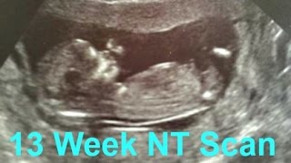 70% Chance it's a GIRL! 13 Week NT Ultrasound Scan