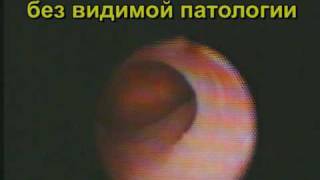 Выскабливание после родов - риск образования спаек.