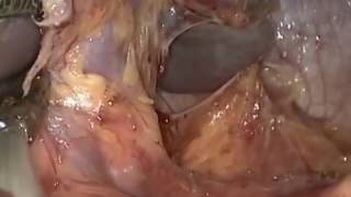 Laparoscopic splenectomy for patient with ITP (non cut video)