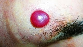 Amazing Lesion/Cyst Removal; Hemangioma & Laser