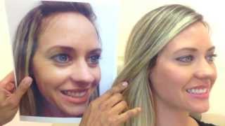 Botox & Restylane- Before & After